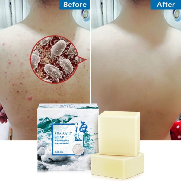 Acne Treatment Sea Salt Soap